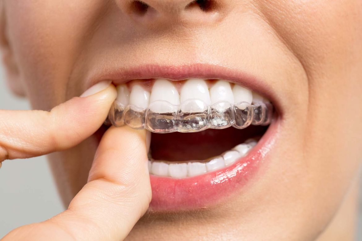 Types of Braces Lingual, Metal, Invisible; Know here!